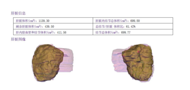 巨大肝母细胞瘤的 - 5.png